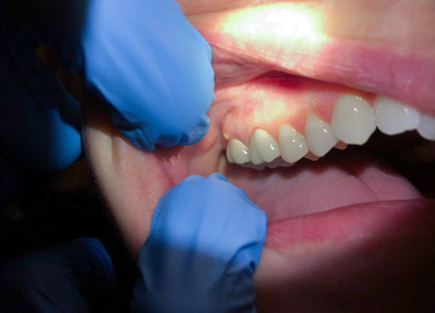 Best Emergency Tooth Extraction in Saugerties South, NY